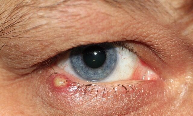 Co na zapalenie dziąseł bez recepty? Co na zapalenie dziąseł bez recepty?